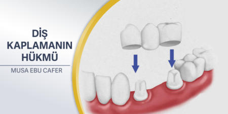 104: Diş Kaplamanın Hükmü