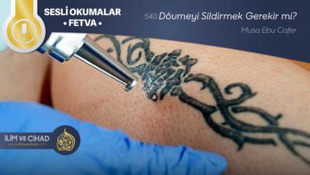 540: Dövmeyi Sildirmek Gerekir mi?